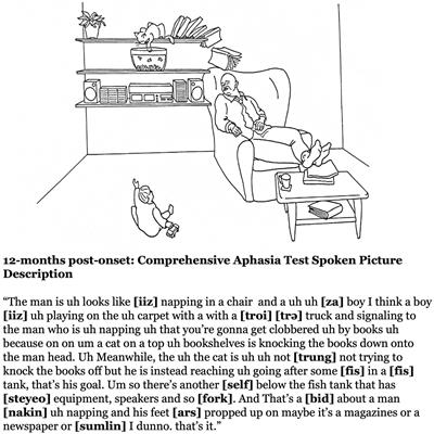 A case of pure apraxia of speech after left hemisphere stroke: behavioral findings and neural correlates